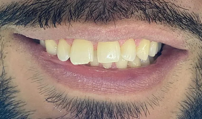 Before dental veneers transformation Las Vegas patient 1